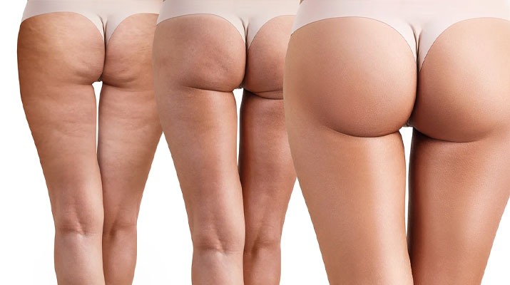 treatment-health-care-brazilian-butt-lift