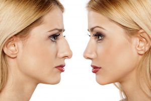 treatment-health-care-rhinoplasty