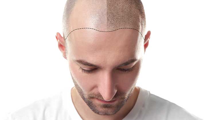 Hair-Transplant